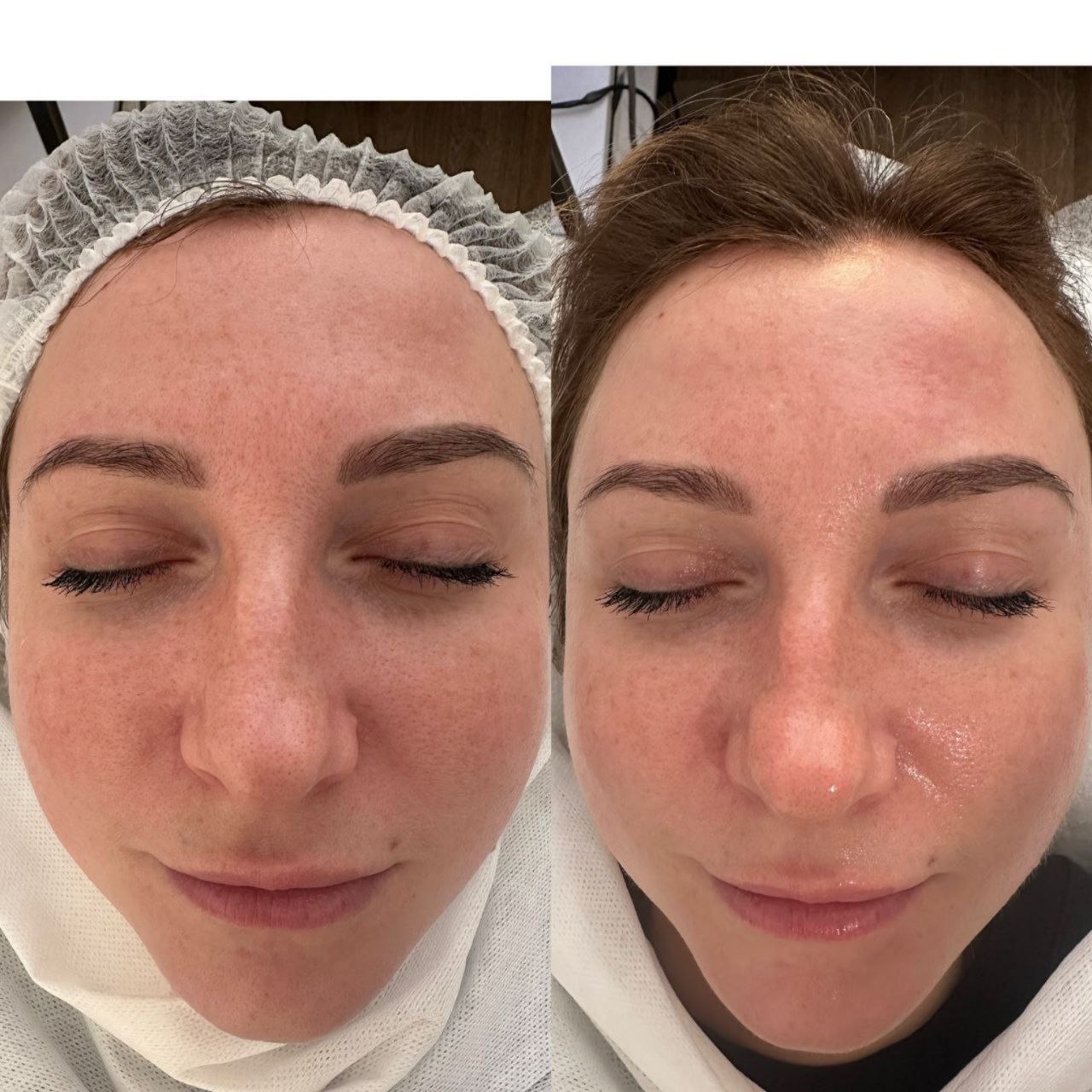 Пример практического применения авторского протокола Intensive Peptide Anti-Age Therapy — Фото № 1