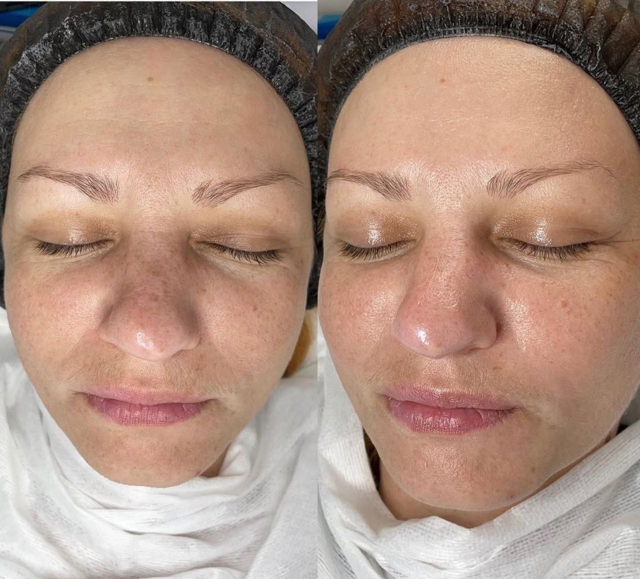 Пример практического применения авторского Skin Brightening — Фото № 10