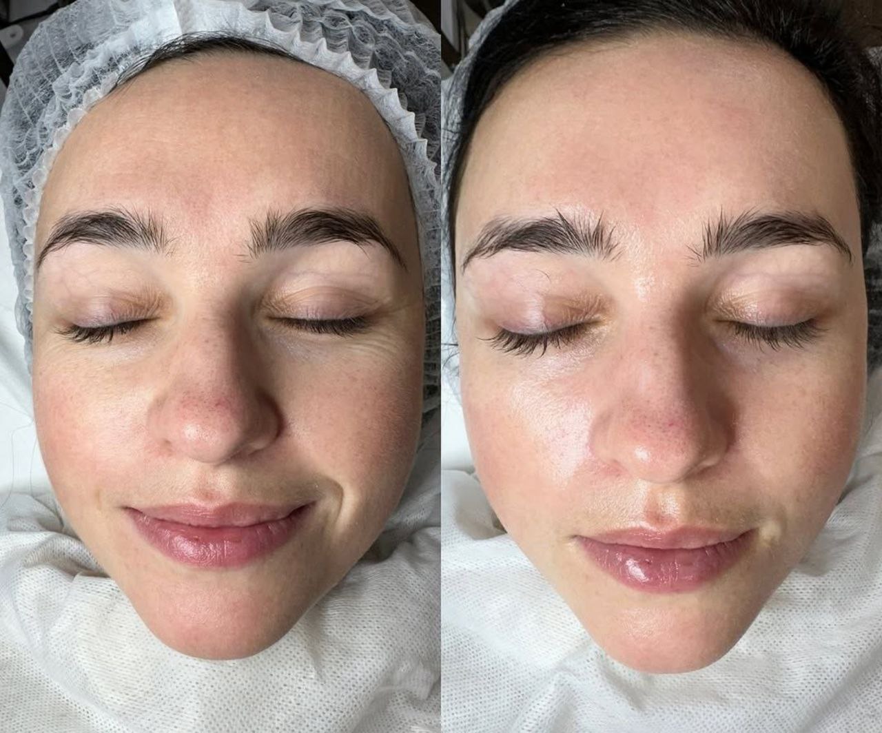 Пример практического применения авторского протокола Intensive Peptide Anti-Age Therapy — Фото № 2