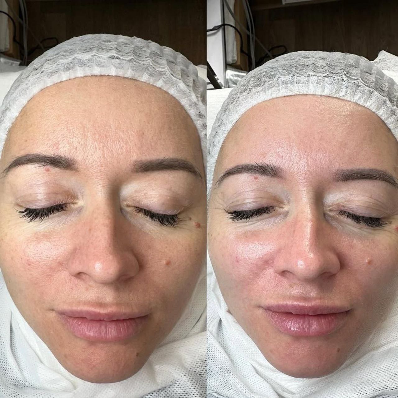 Пример практического применения авторского протокола Intensive Peptide Anti-Age Therapy — Фото № 3