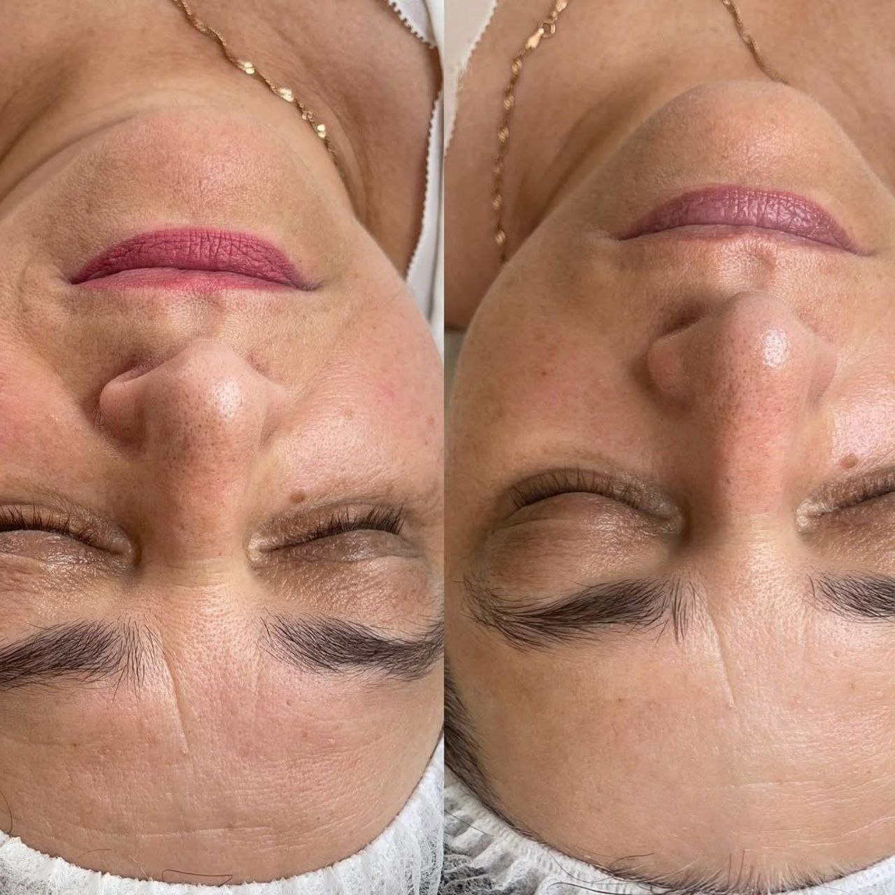 Пример практического применения авторского протокола Intensive Peptide Anti-Age Therapy — Фото № 4