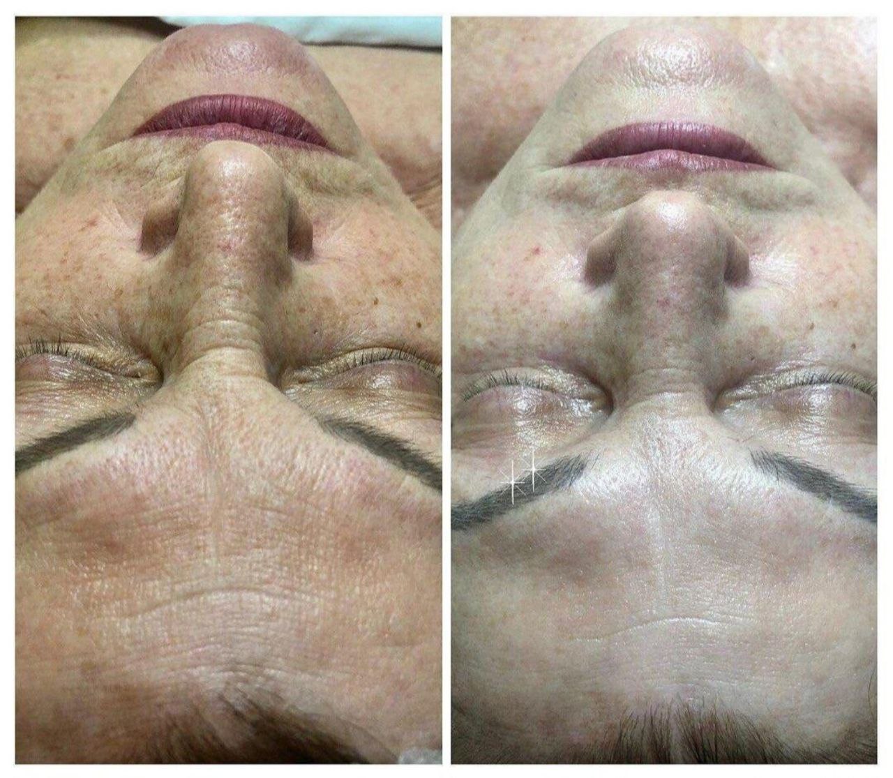 Пример практического применения авторского протокола Intensive Peptide Anti-Age Therapy — Фото № 5