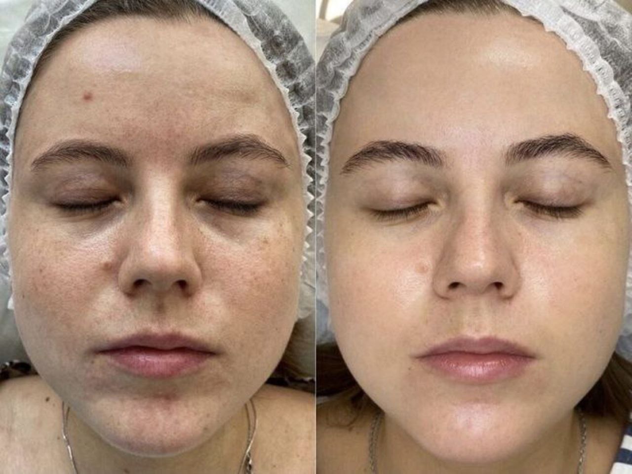 Пример практического применения авторского Skin Brightening — Фото № 7